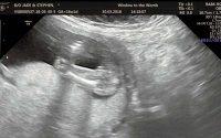 giật mình với hình ảnh siêu âm của thai nhi