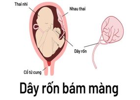 day-ron-bam-mang-la-gi-anh-huong-nhu-the-nao-den-thai-nhi