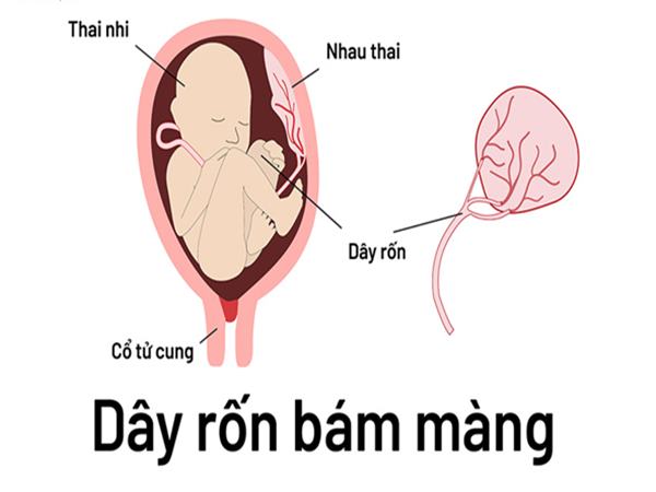 day-ron-bam-mang-la-gi-anh-huong-nhu-the-nao-den-thai-nhi