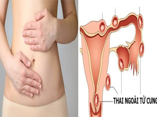 Mang thai ngoài tử cung 