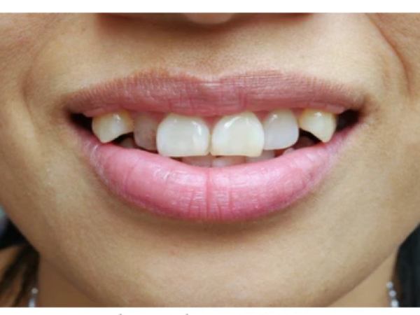 Vận mệnh nam giới có tướng răng chó