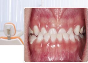 tướng răng quặp vào trong